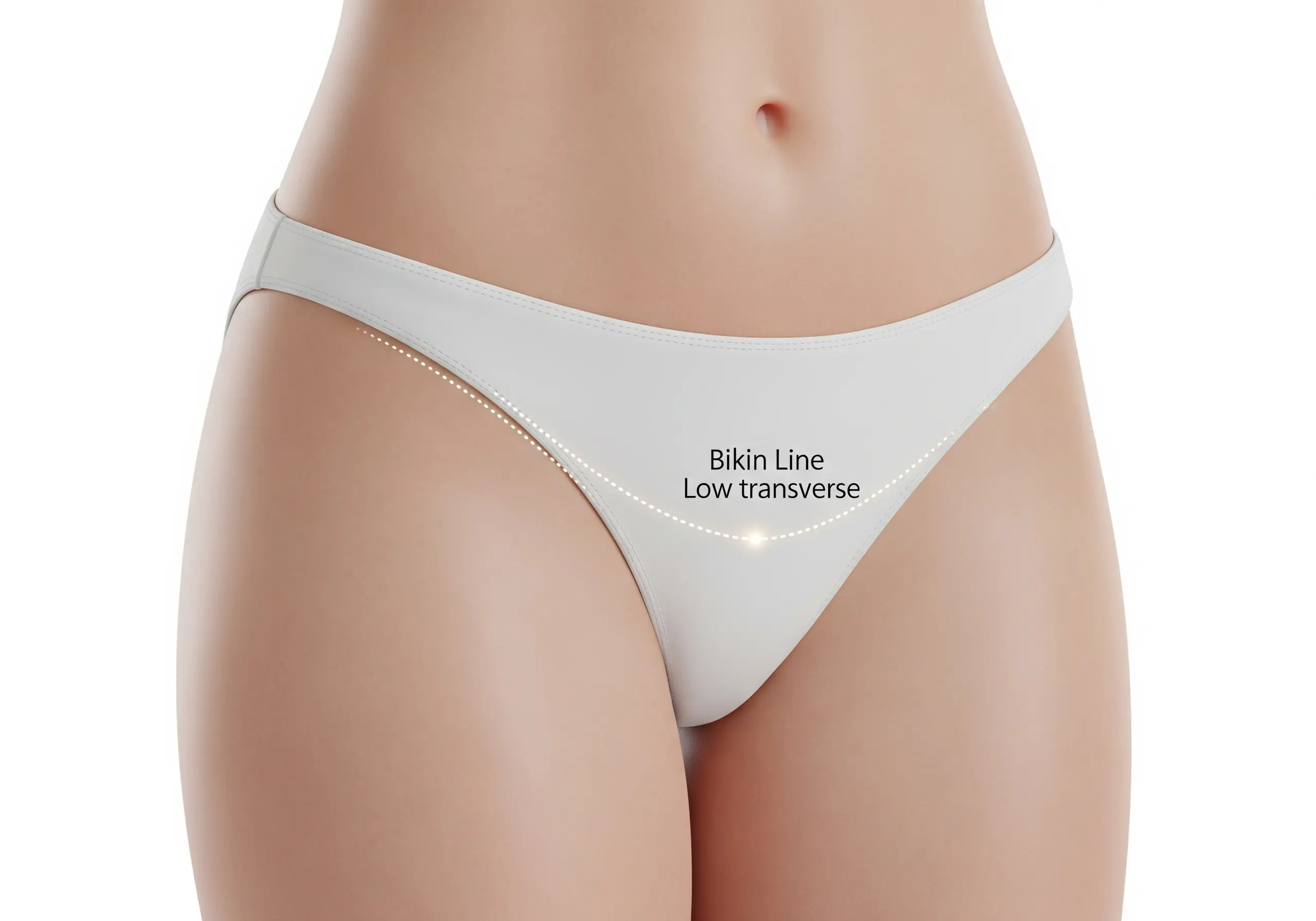 3D medical illustration showing the location of a standard bikini-line incision for an abdominal hysterectomy